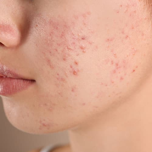 Acne
